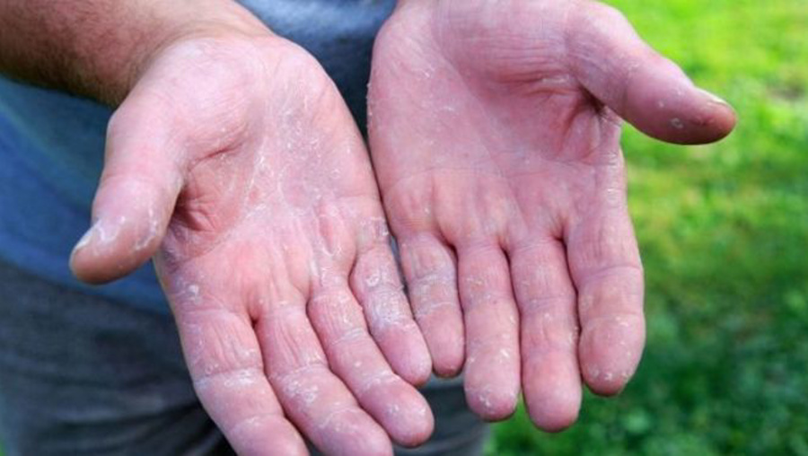 Çığır açan keşif: Egzamanın nedeni bulundu